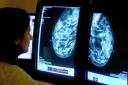 3,000 women invited for breast screening in St Helens did not attend, stats show
