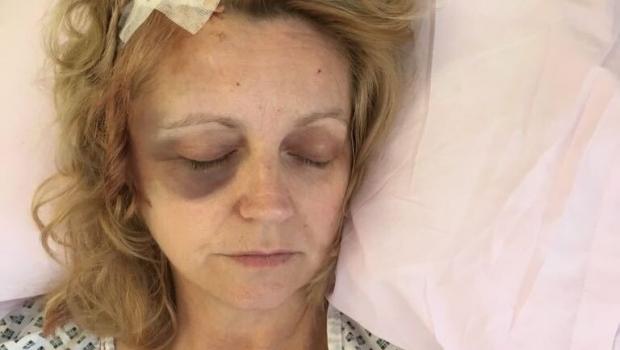 St Helens Star: Karen after her first operation