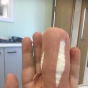 David O'Keefe's bandaged hand
